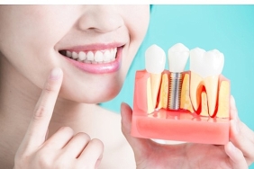 dis-implantlari-hakkinda-bilmeniz-gereken-9-bilgi.jpg