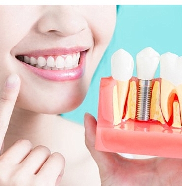 dis-implantlari-hakkinda-bilmeniz-gereken-9-bilgi.jpg